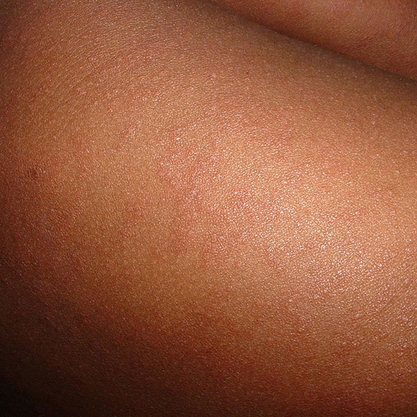 measles reemerging infectious disease